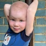 bambino africano, albinismo,